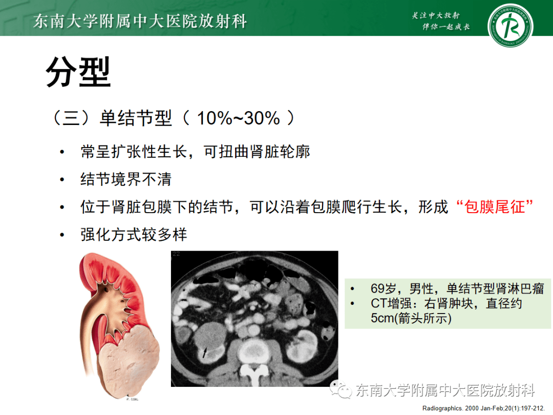 肾脏淋巴瘤影像表现_全网_解剖图_患者