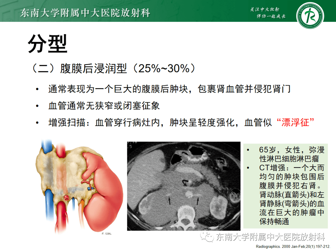 腎臟淋巴瘤影像表現_全網_解剖圖_患者