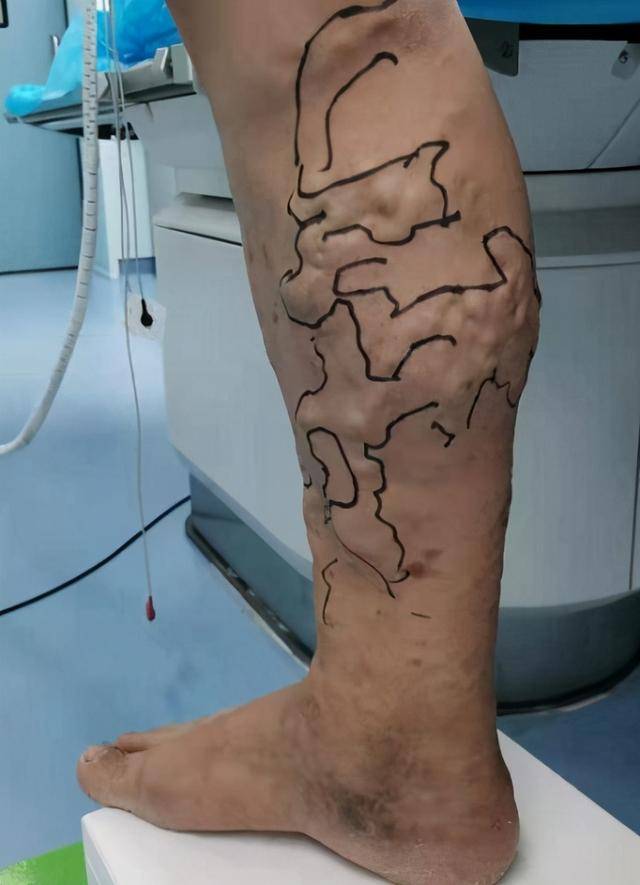 小腿居然长满"蚯蚓"介入治疗消除深圳阿叔10年困扰