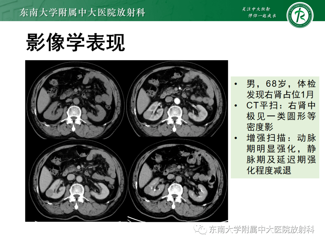 腎臟淋巴瘤影像表現_全網_解剖圖_患者