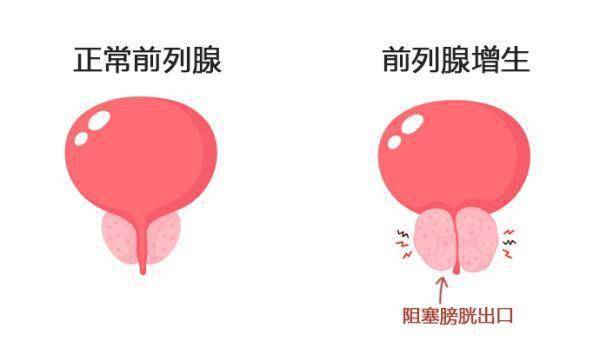 小事|夜尿多不是小事！需警惕4种疾病