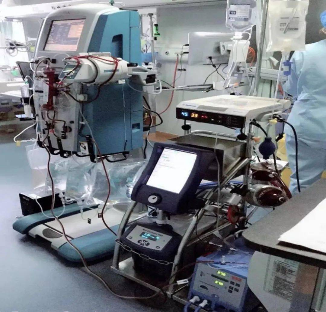 圖 | icu患者同時進行ecmo,床旁血濾治療在icu,木子每週有四天連續兩