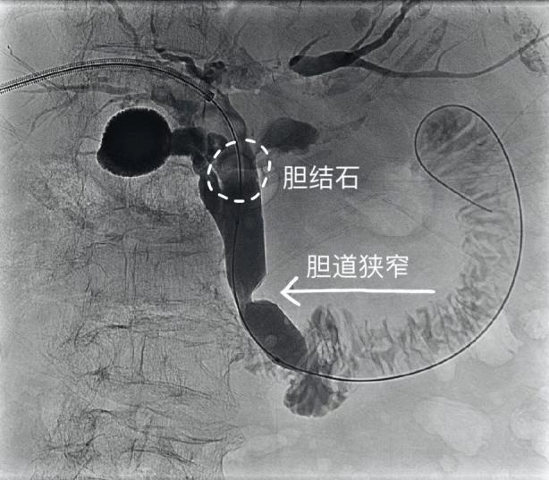 分期介入 精准治疗 为九旬老人解除胆结石困扰_胆管_医学科_患者