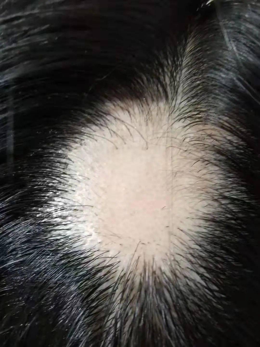 斑秃最有效的治疗方法图片