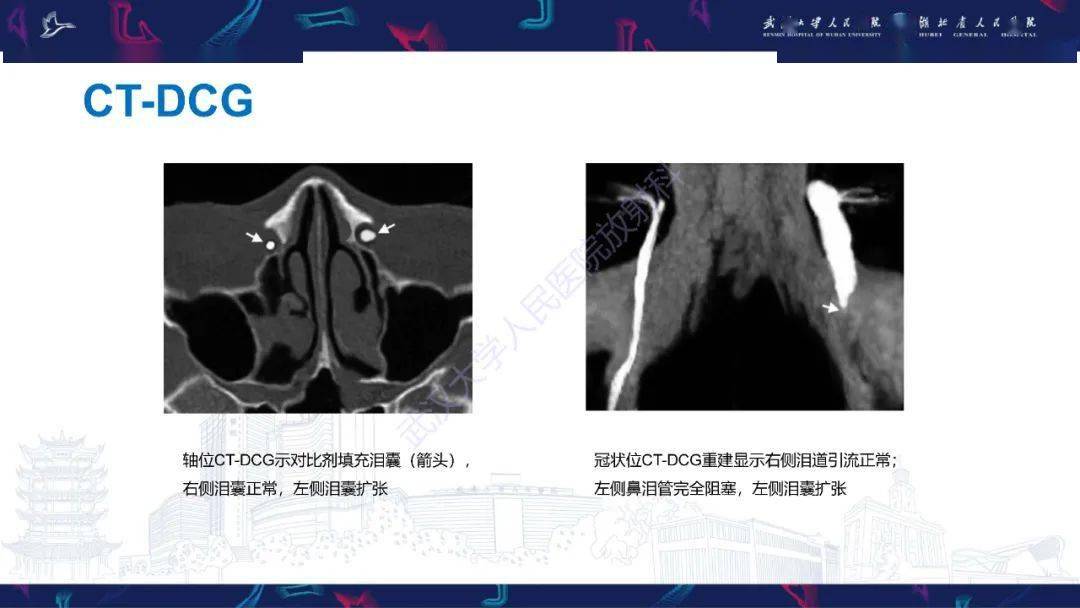 泪道病变影像诊断