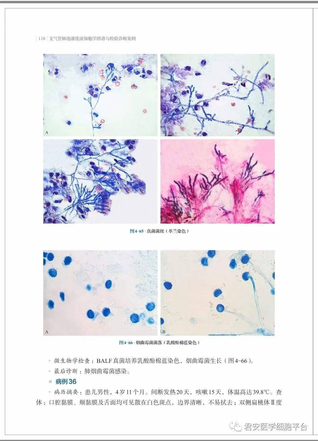 end往期回顧肺泡 蛋白沉積症段師形態教學系列(第40期)體液細胞形態學