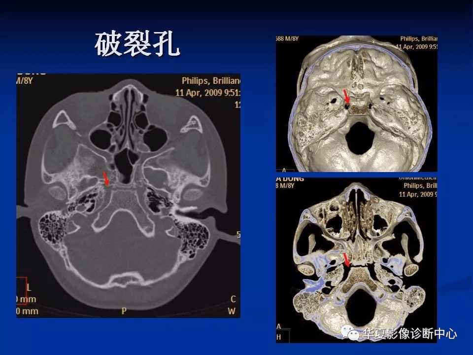 实用,详细的颅底各孔道影像解剖