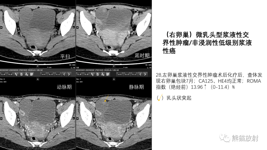 卵巢囊腺瘤CT图片