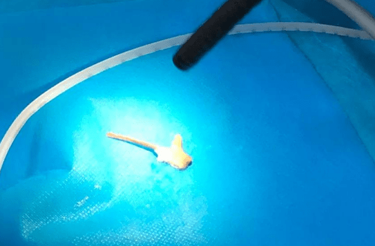 4厘米鸡骨头卡在90岁高龄老人食管,多学科大抢救患者转危为安_异物_卢