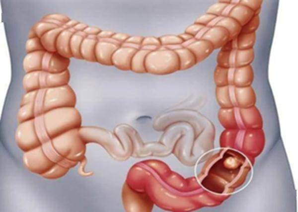 肠道|警惕！它是癌症的“近亲”？这个习惯是诱因→