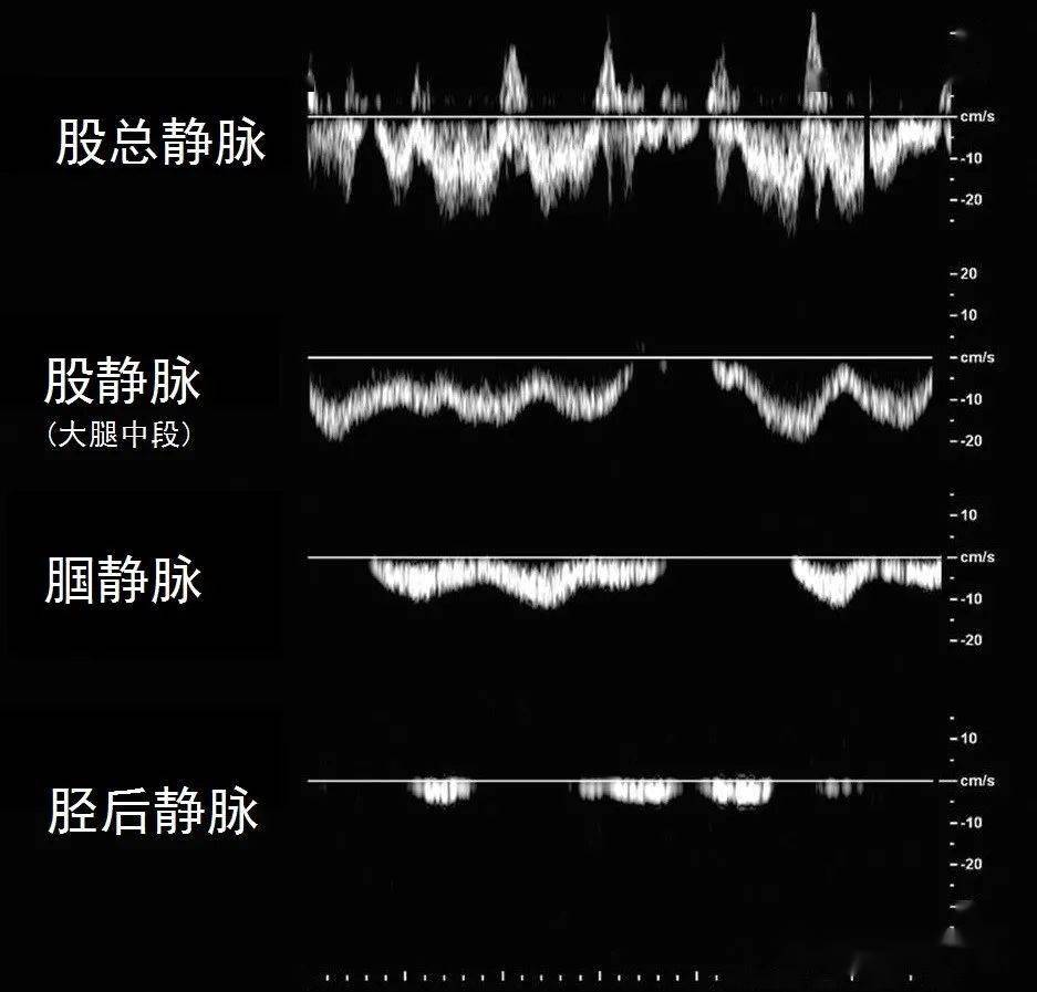 血管超声基础61静脉频谱的期相性