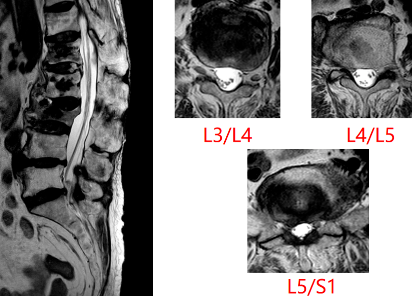 腰椎mri提示,l3/4,l4/5,l5/s1椎间盘向四周膨出