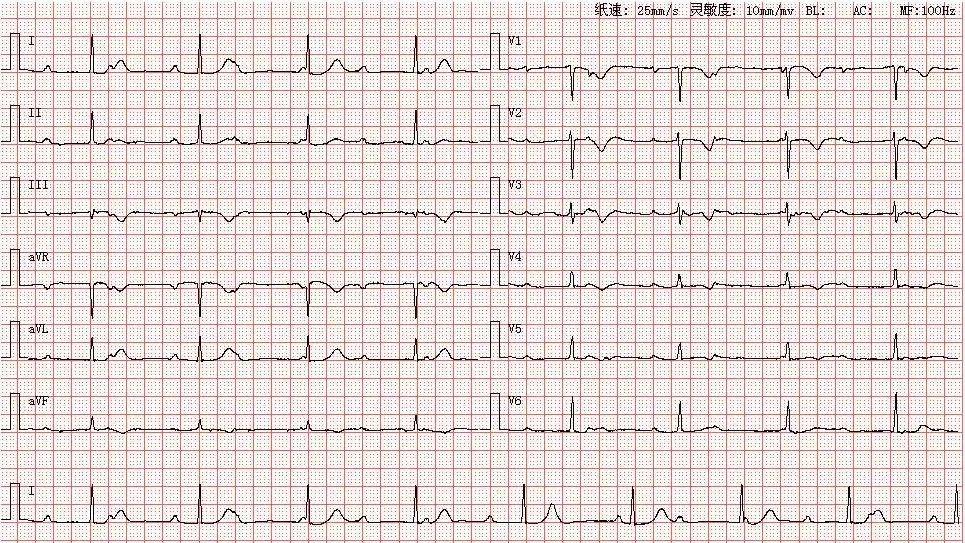 心電圖庫丨三度房室傳導阻滯系列