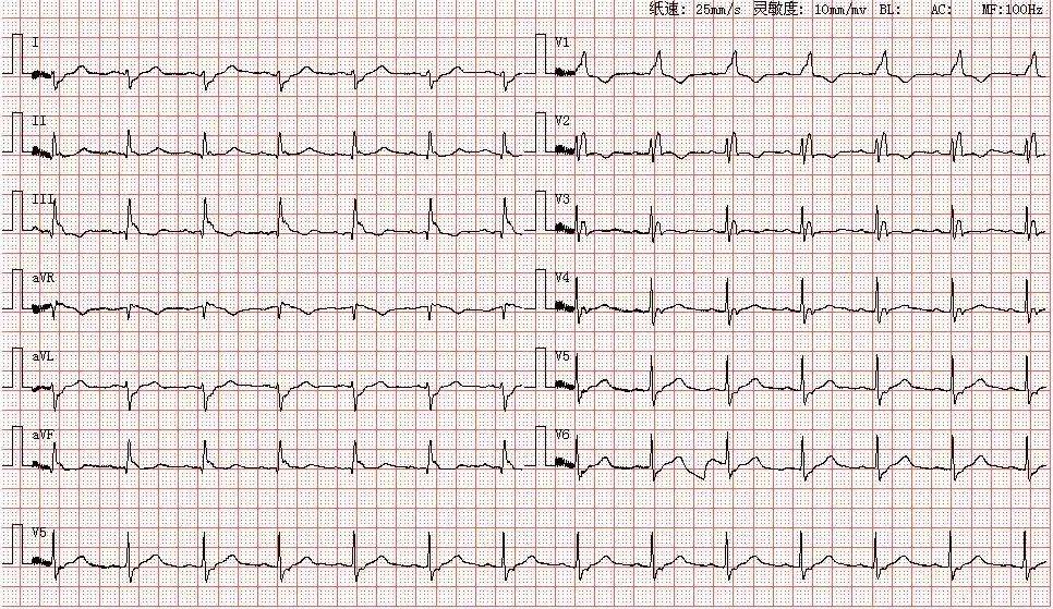 心电图库丨完全性右束支阻滞系列_窦性_心律_avr