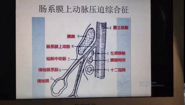 肠系膜上动脉压迫综合征
