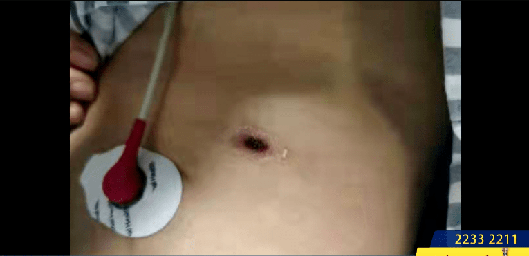 肝功能|女子逗猫后进了ICU，医生提醒：这种病在南方多发