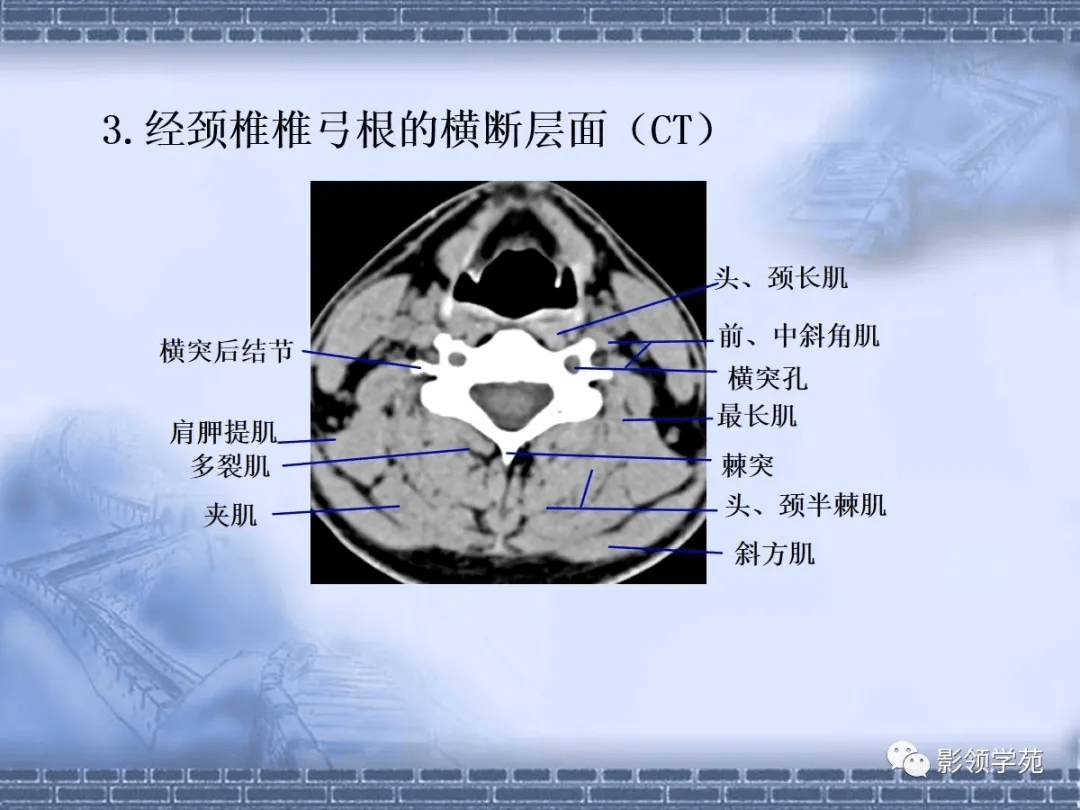 頸椎腰椎ct常見病變