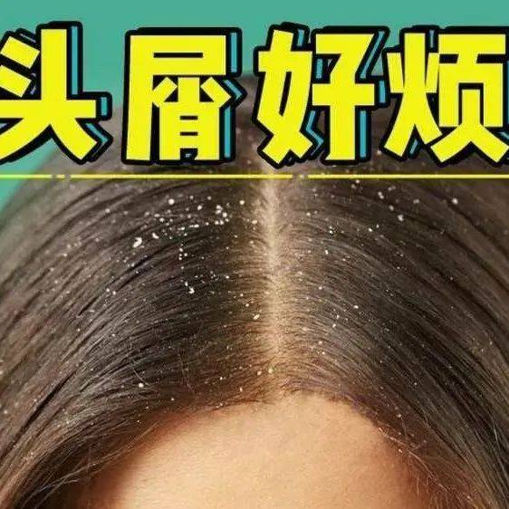 你是否也有头皮屑多的苦恼?去除头屑 洗发水应这样选!_洗头_头发_油脂