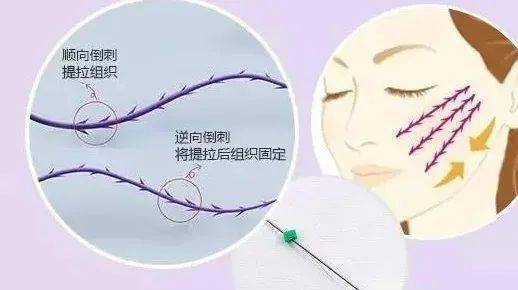 什么法令纹消失术？亲测有效！
