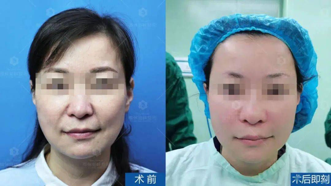 什么法令纹消失术？亲测有效！