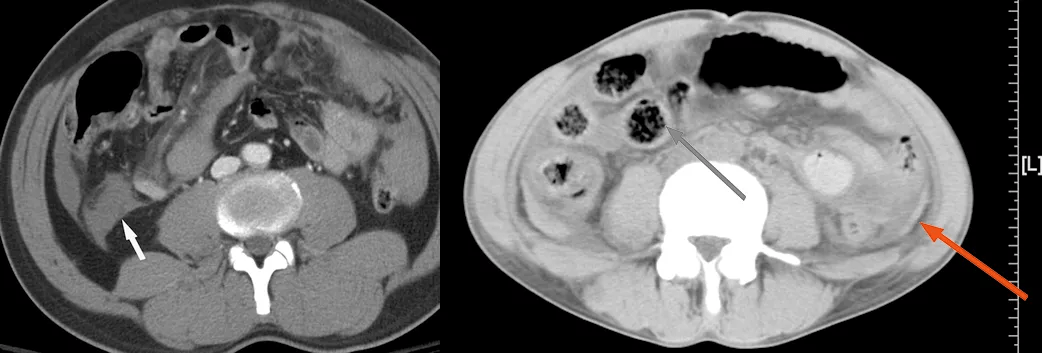 外伤患者如何看肠管掌握这些影像征象就够了
