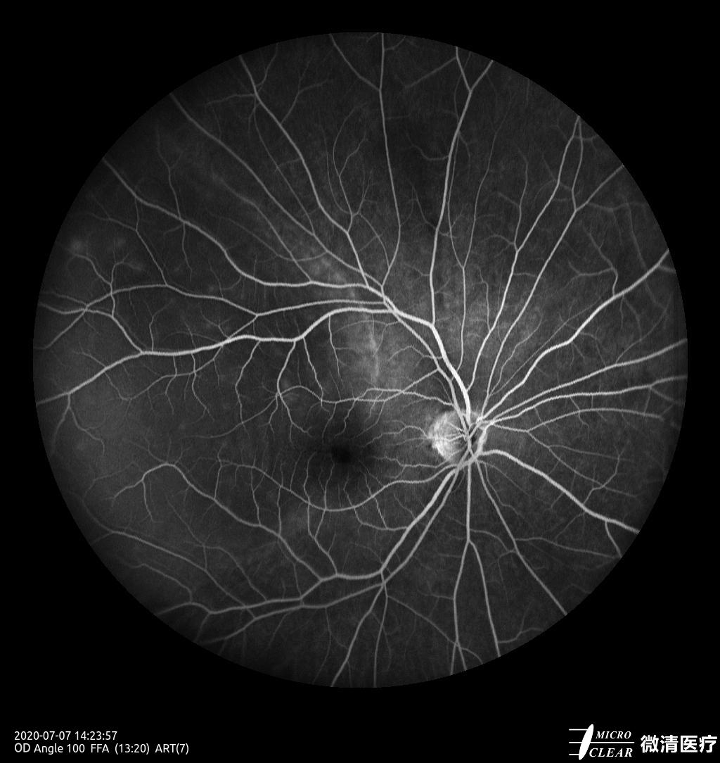 视网膜脱落闪光感图片图片