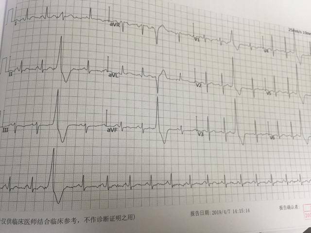 当然,很多心律失常是阵发的,心电图正常也不能排除,经常需要结合