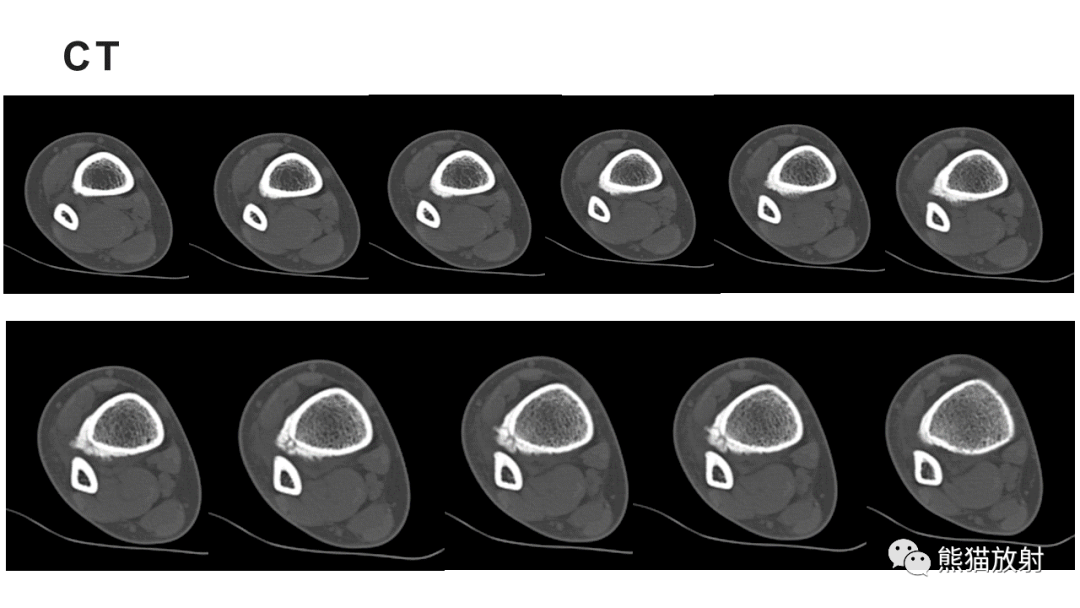 12_内容_骨瘤_骨髓炎