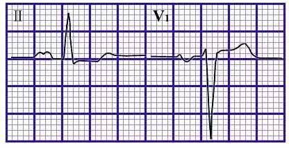 看图学心电图仅供参考