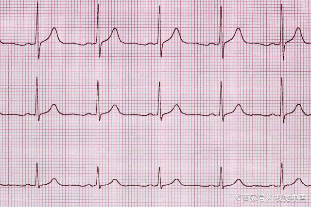 體檢心電圖報告結果是竇性心律,到底是否正常?_心臟_情況_功能