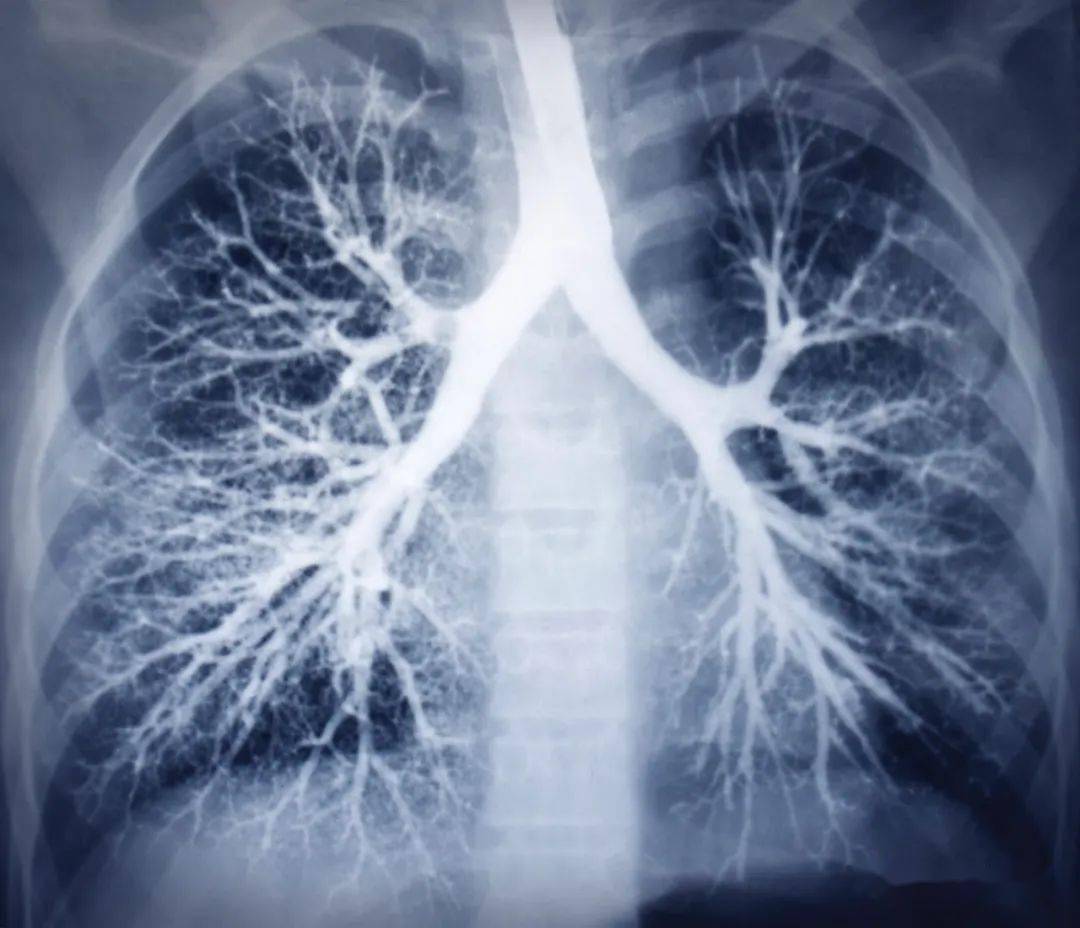 常见慢性病之阻塞性肺疾病