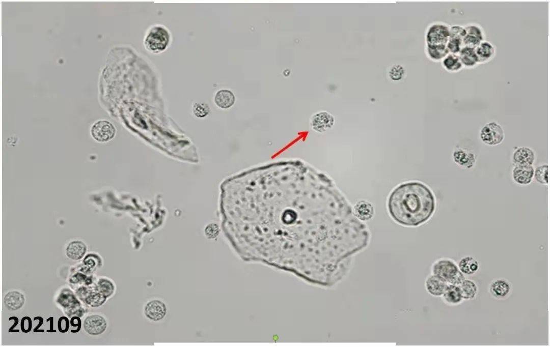 尿复粒细胞图片图片