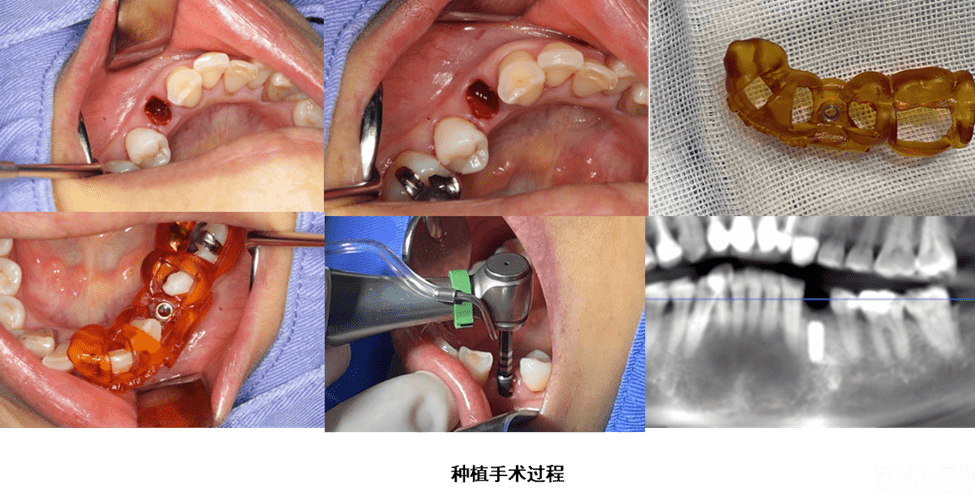 数字化3d种植导板上线 开启精准微创种牙新时代_创新中心_临床_技术