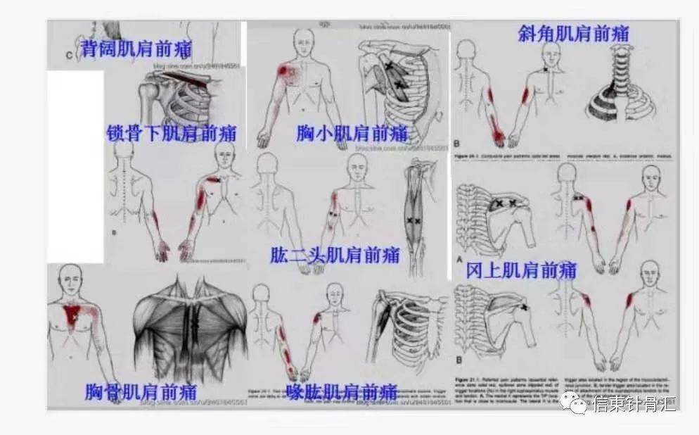 肌筋膜全身160个疼痛触发点