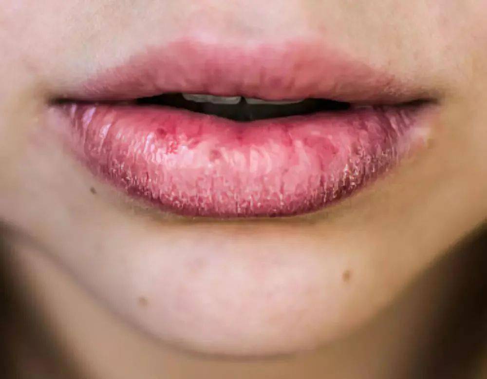 嘴唇干燥起皮还在撕嘴唇越舔越干原来是身体在求救健康日历