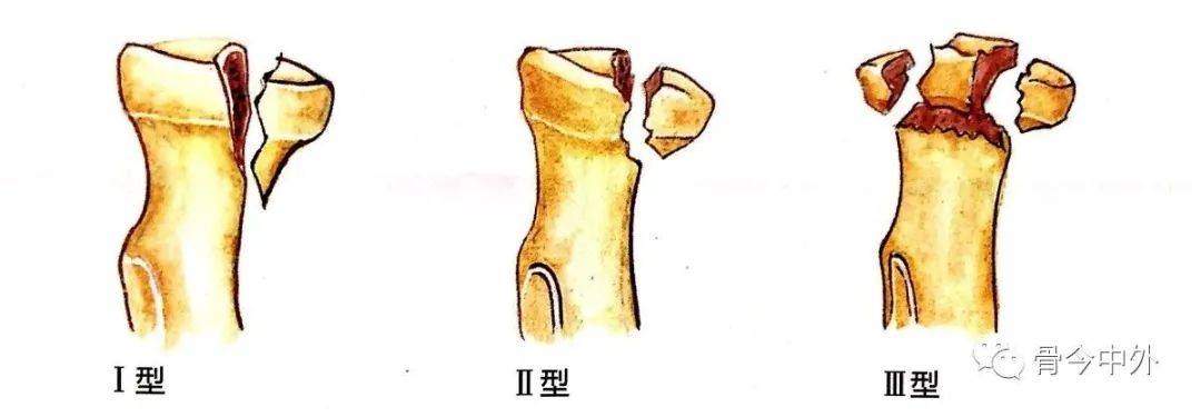 图2:桡骨头骨折mason分型示意图治疗原则