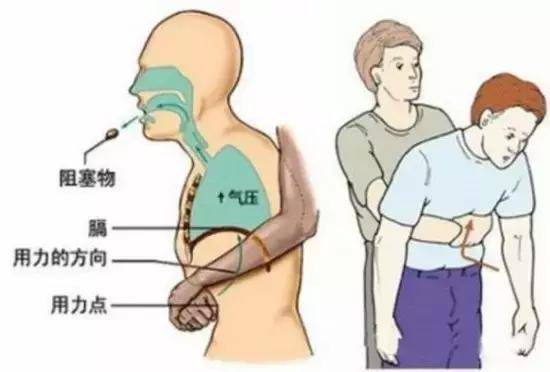 吃饭进入气管怎么办