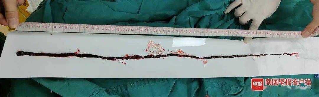 血管|惊！七旬老人突发“腿梗”？医生：再晚点儿或要截肢！