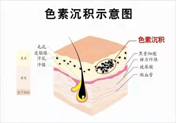 果酸泗阳小姐姐看过来，你们要的美白淡斑方法找到了