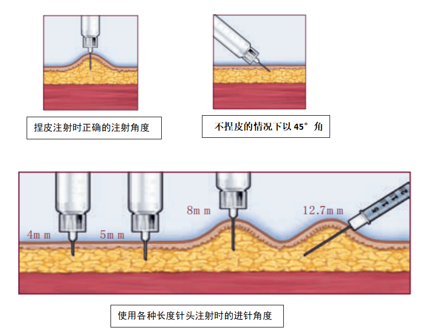 胰岛素打针时疼痛降糖效果不理想看看是否犯了这些错误