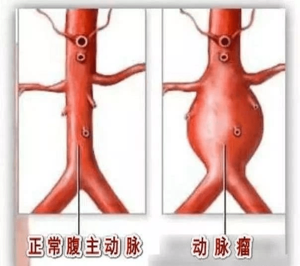 手术|腰痛1个月竟是体内藏瘤？医生“拆弹+肾搬家”切除“炸弹”