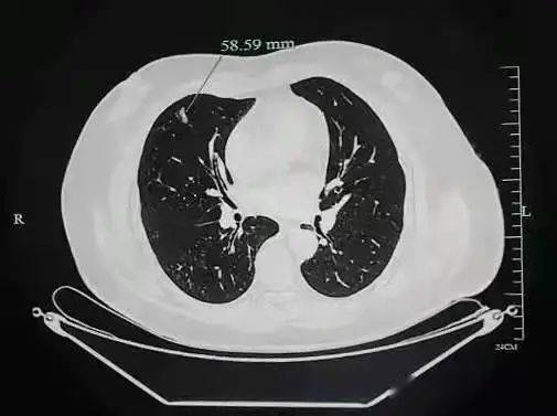 成功|【新闻快递】医院成功实施经皮穿透肋软骨肺穿刺活检术