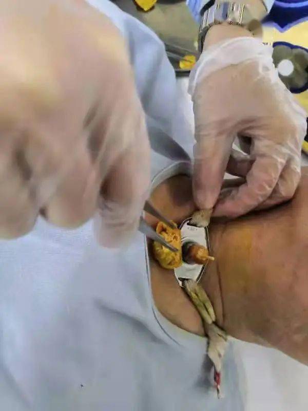 中医微资讯气管插管患者的中医康复历程