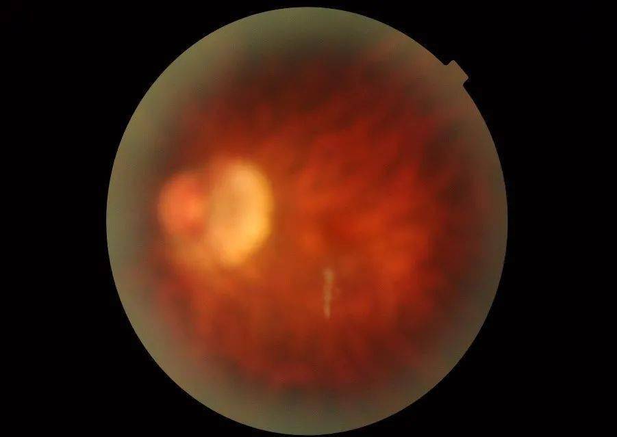 经散瞳仔细诊断,先生被确诊为老年性玻璃体混浊,也就是俗称的飞蚊症.