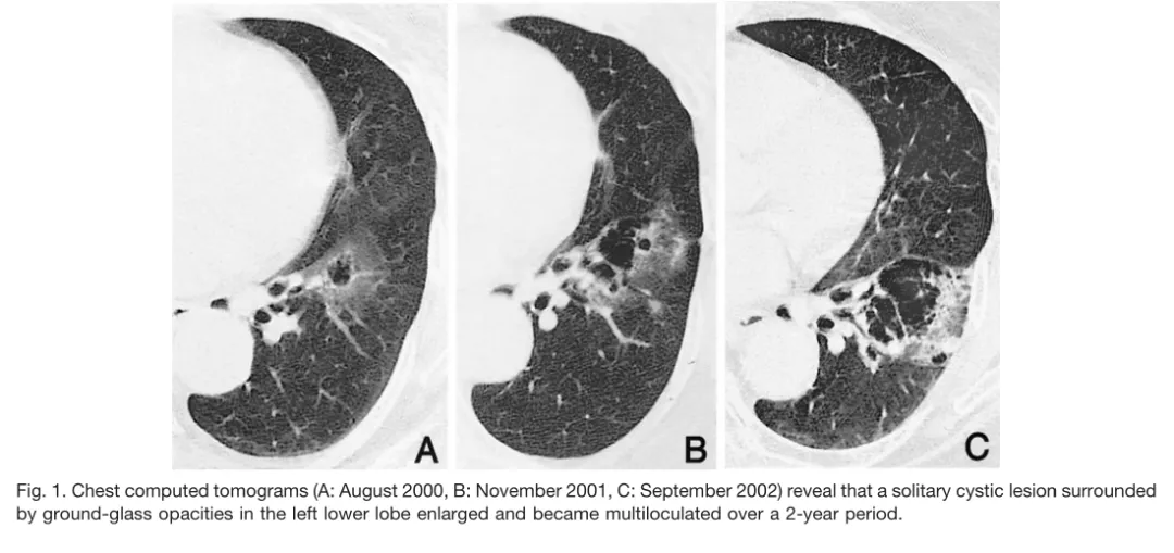 非常有趣的肺ct莲蓬征你见过吗