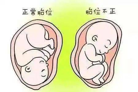 脐带|胎位不正，可以顺产吗？看“臀位宝宝”如何“华丽转身”