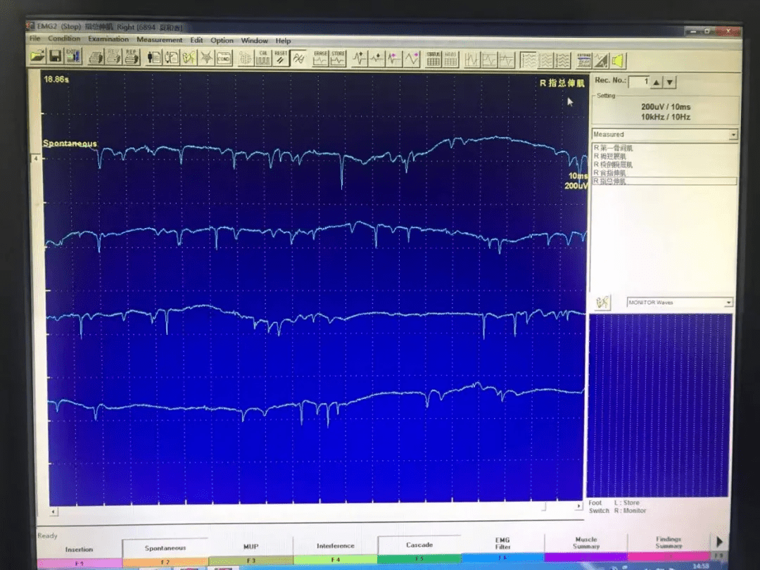 肌電圖的檢查過程是怎樣的檢查肌肉時電極針插入肌肉的痠痛感,檢查