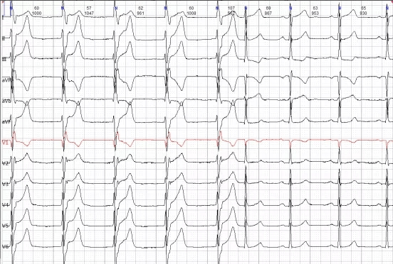 心电图不会看这10个诊断特征需牢记
