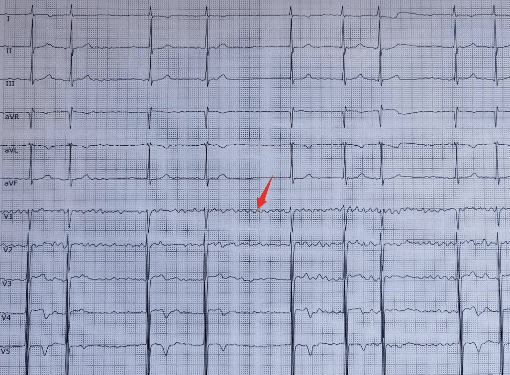 v1 导联明显,f 波的大小,极性,形态不同,频率较快,qrs 波的频率(心室