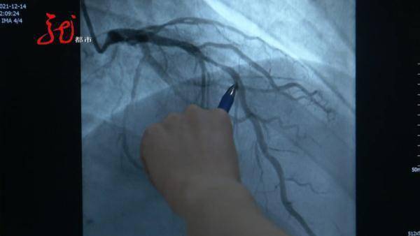 胸痛|血管“断”了，36岁医生倒下！这类人群要警惕！